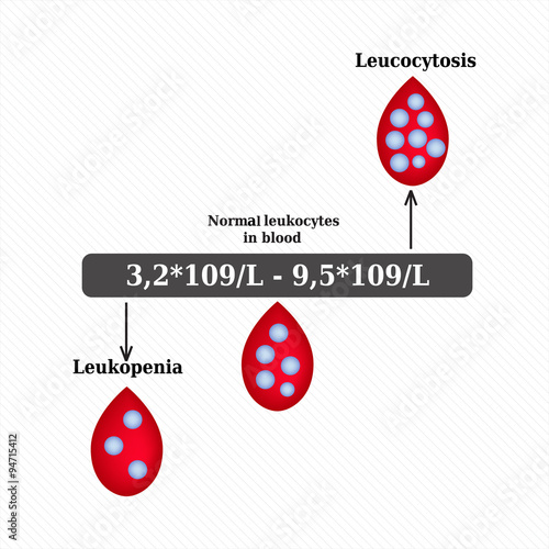White blood cell count. Leukopenia. Leukocytosis. Infographics. Vector illustration