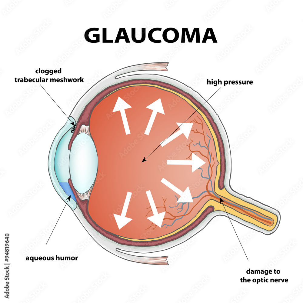 Glaucoma Stock Vector Adobe Stock