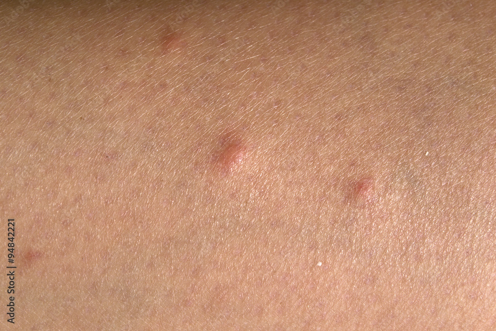 Fototapeta premium Human skin irritated after mosquito bites