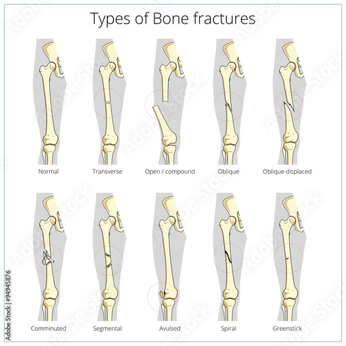 Valokuvatapetti Types of bone fractures medical educational vector