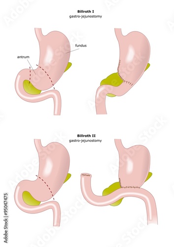 resezione parziale dello stomaco secondo Billroth