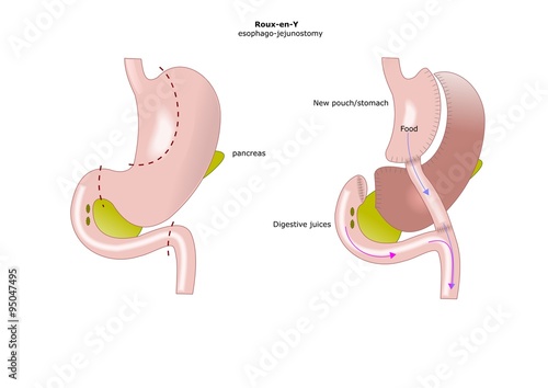 resezione chirurgica di parte dello stomaco per ridurre l'assorbimento dei cibi