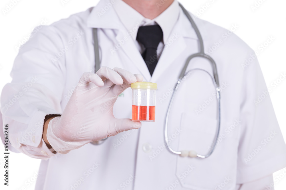 doctor's hand holding a bottle of bloody urine sample doctor's hand holding a bottle of bloody urine sample