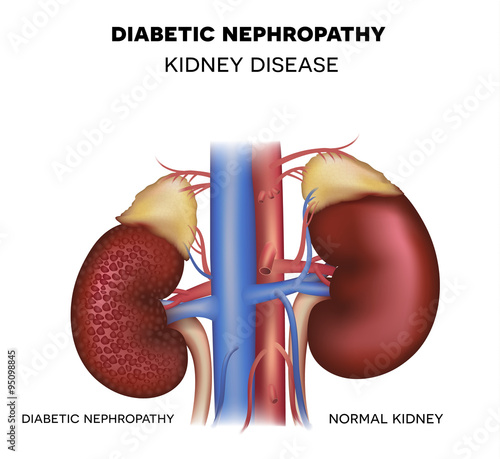 Diabetic Nephropathy, kidney disease photo