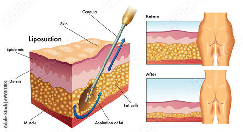 liposuzione photo