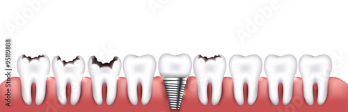 Various teeth conditions