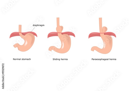 principali tipi di ernia esofagea photo
