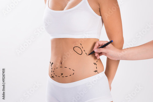 Surgeon Preparing Woman For Liposuction Surgery photo