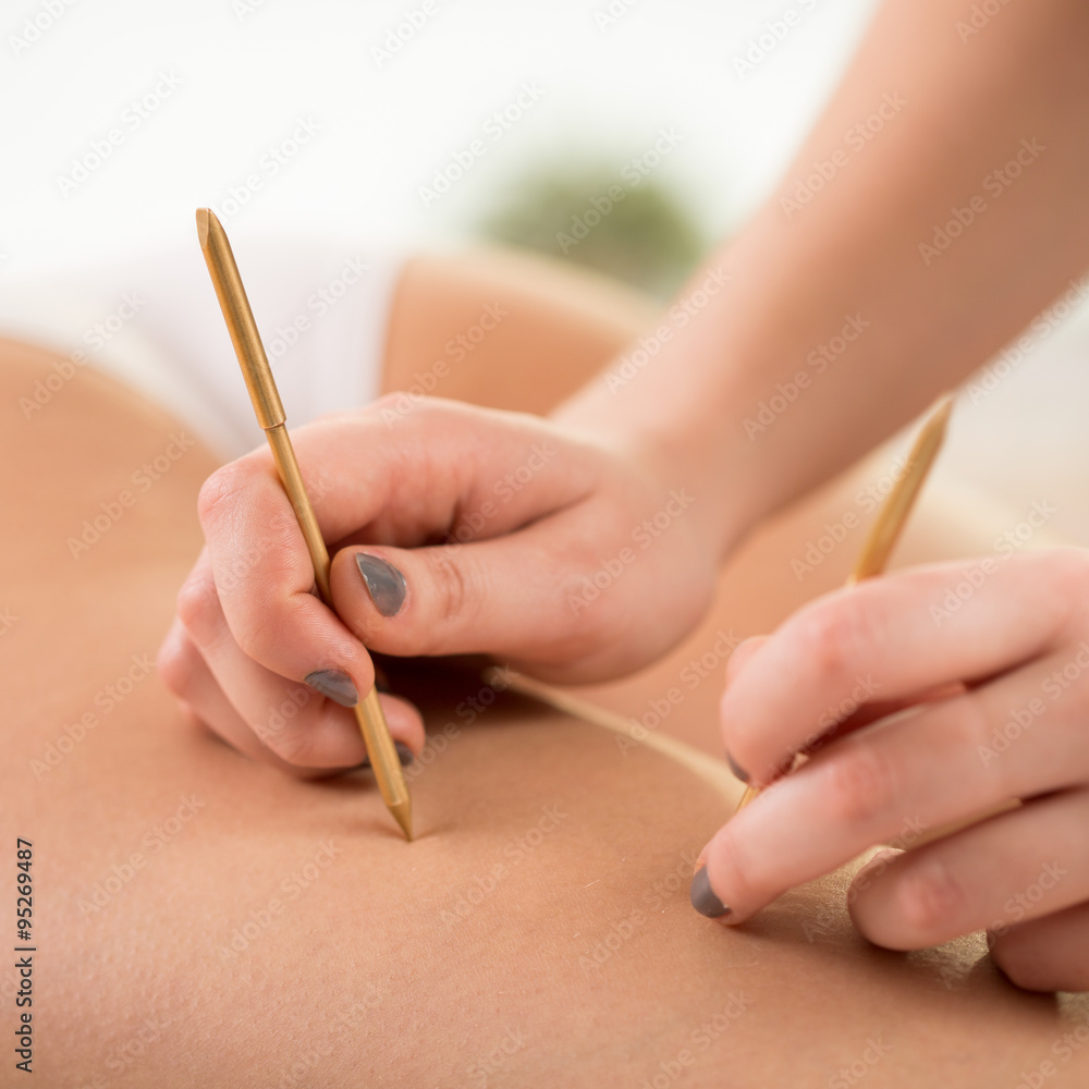 Using acupuncture to reduce cellulite Using acupuncture to reduce cellulite