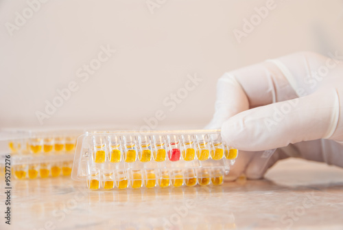 Laboratory doctor holding a urine test for Mycoplasma and Ureaplasma urealyticum, this is showing a positive result with these bacteria