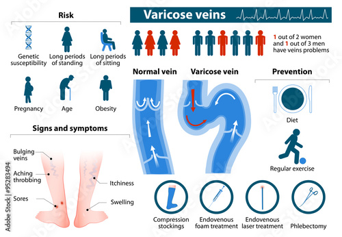 Varicose Veins