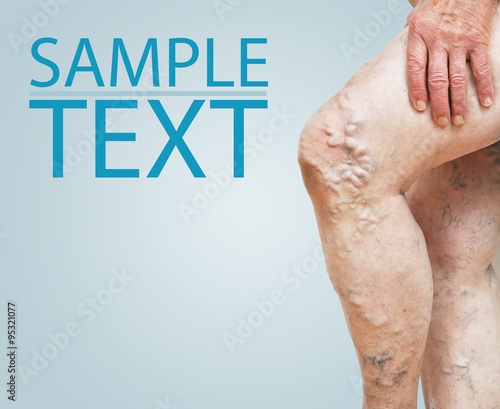 Legs with varicose veins