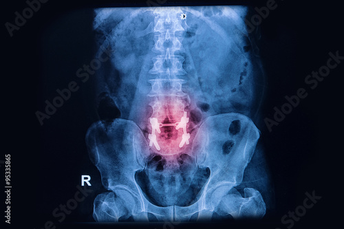Lumbar Osteosynthesis ,lumbar spinal column with internal fixati