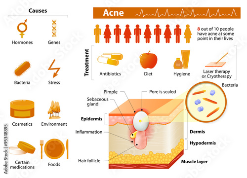 Acne. skin problems. medicine in medical infographics.