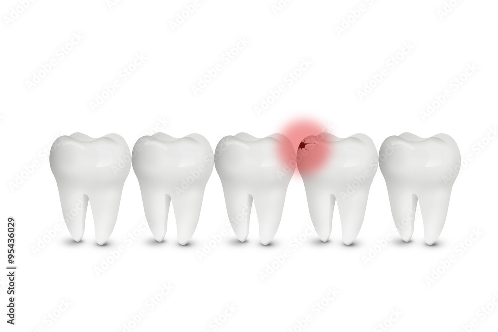 tooth with tooth-hole on a white background tooth with tooth-hole on a white background