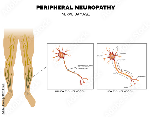 Neuropathy, nerve damage