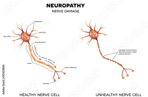 Neuropathy, nerve damage photo