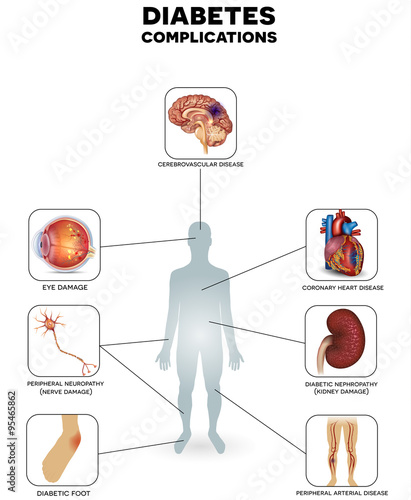 Diabetes complications, affected organs. Diabetes affects nerves, kidneys, eyes, vessels, heart and skin.