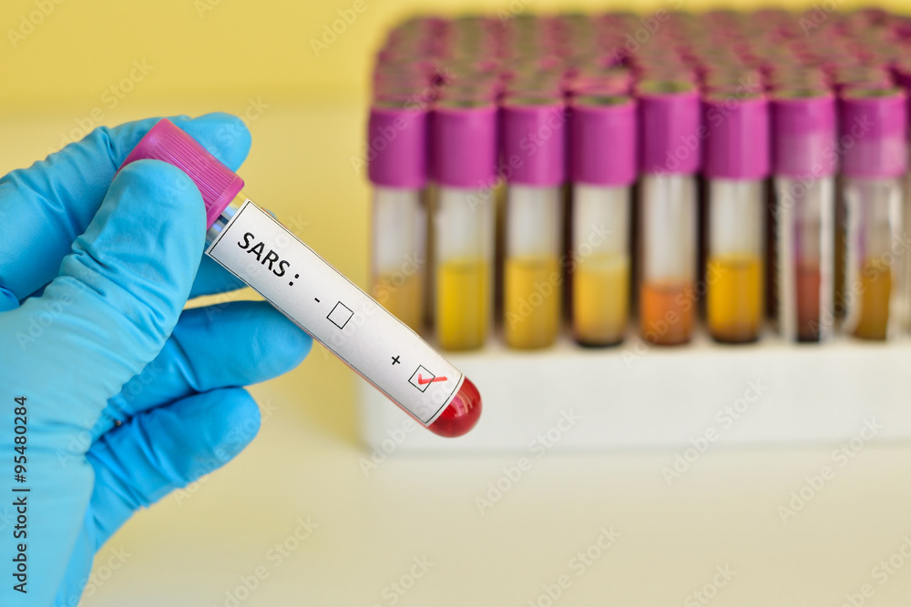 Fototapeta premium SARS positive blood sample