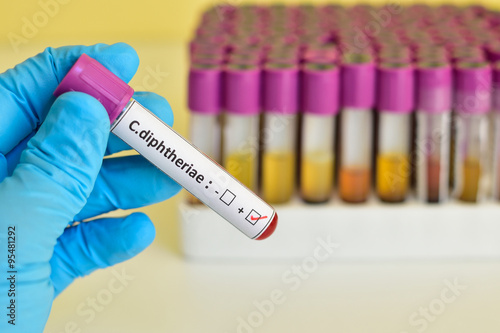 Corynebacterium diphtheria positive blood sample photo
