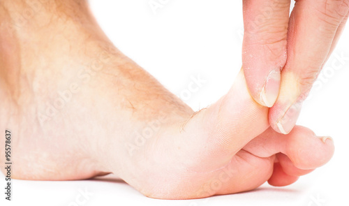 Tableau sur toile Male person pulling big toe backwards isolated towards white