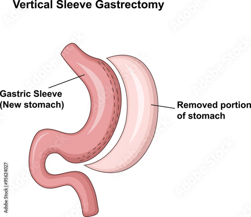 Illustration of Vertical Sleeve Gastrectomy (VSG)