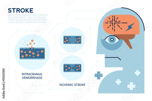 Stroke Brain Disease