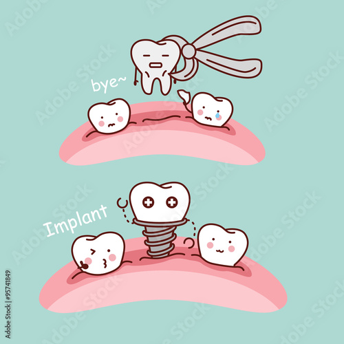 cartoon tooth extract and implant