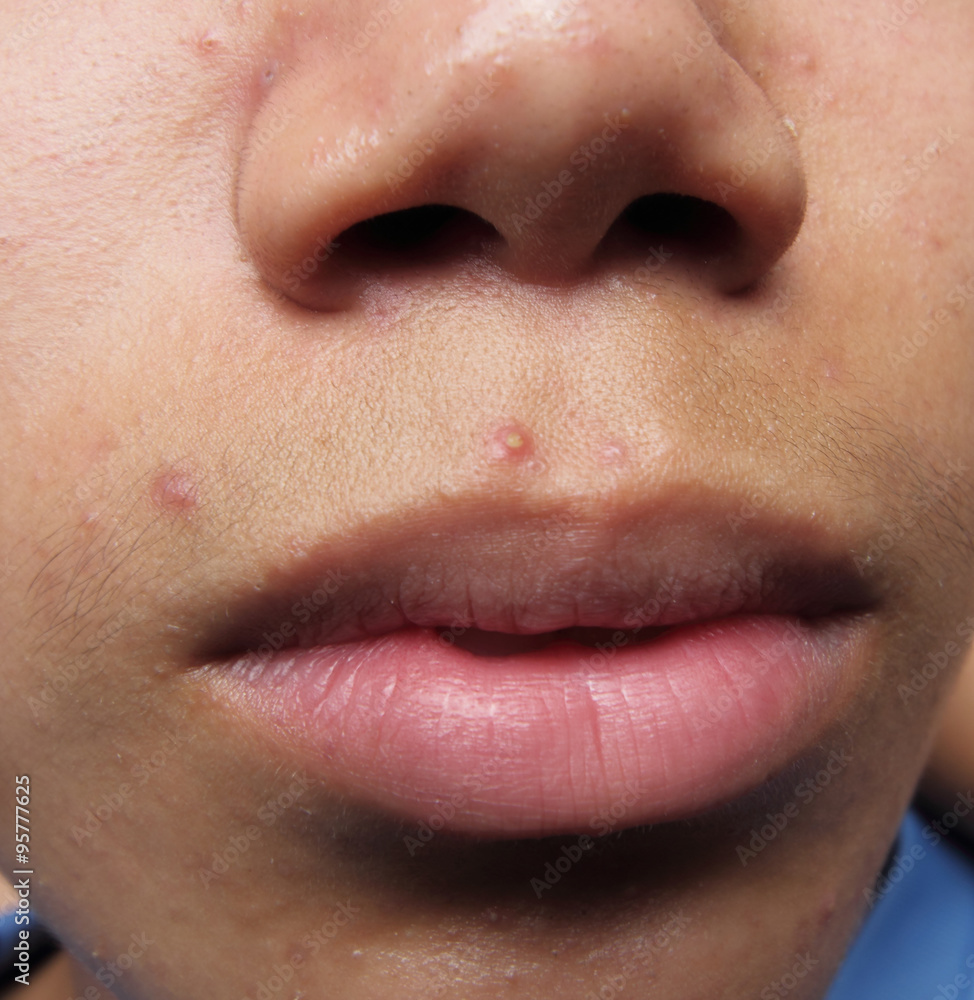 Fototapeta premium Pimples and acne on the face of an Asian teenager.