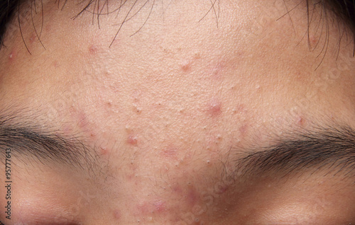 Photos Pimples and acne on the forehead of an Asian teenager.