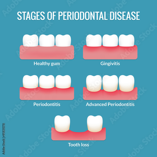 Periodontal Disease Chart