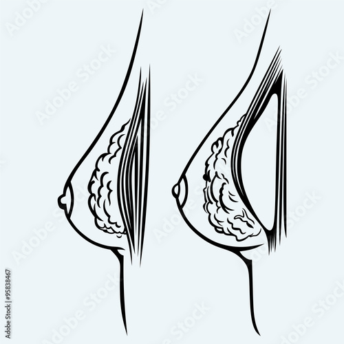 Plastic surgery. Breast implant. Isolated on blue background. Vector silhouettes