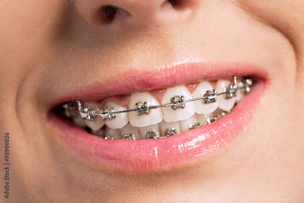 Fototapeta premium Happy success smile with perfect teeth and braces