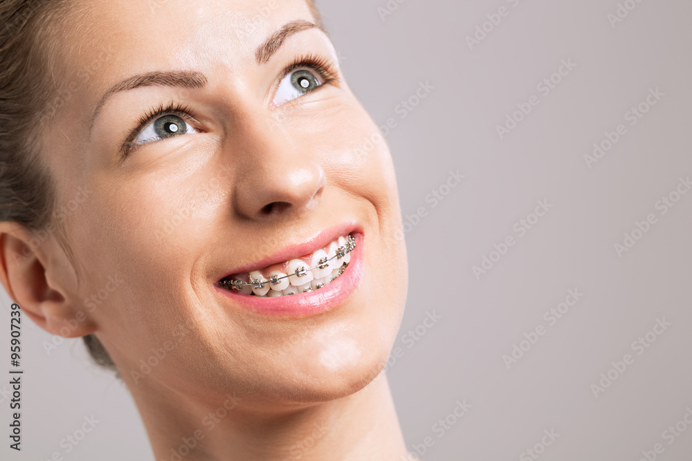 Obraz premium Braces Teeth Female Smile