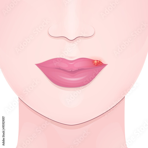 cold sore lip
