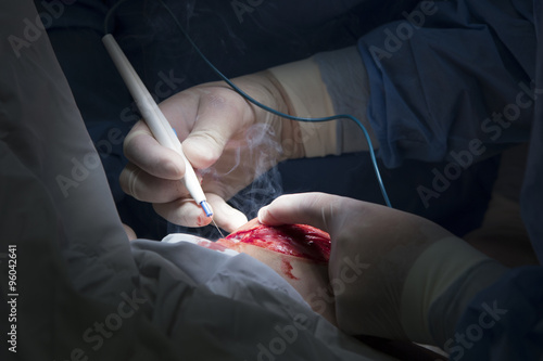 Electrosurgery © vzmaze