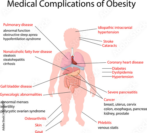 Illustration of Medical Complication of Obesity