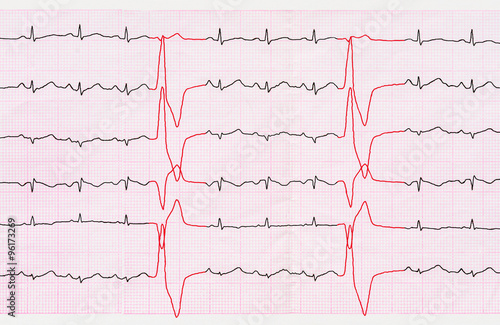 Tape ECG with ventricular premature beats (quadrigeminia)