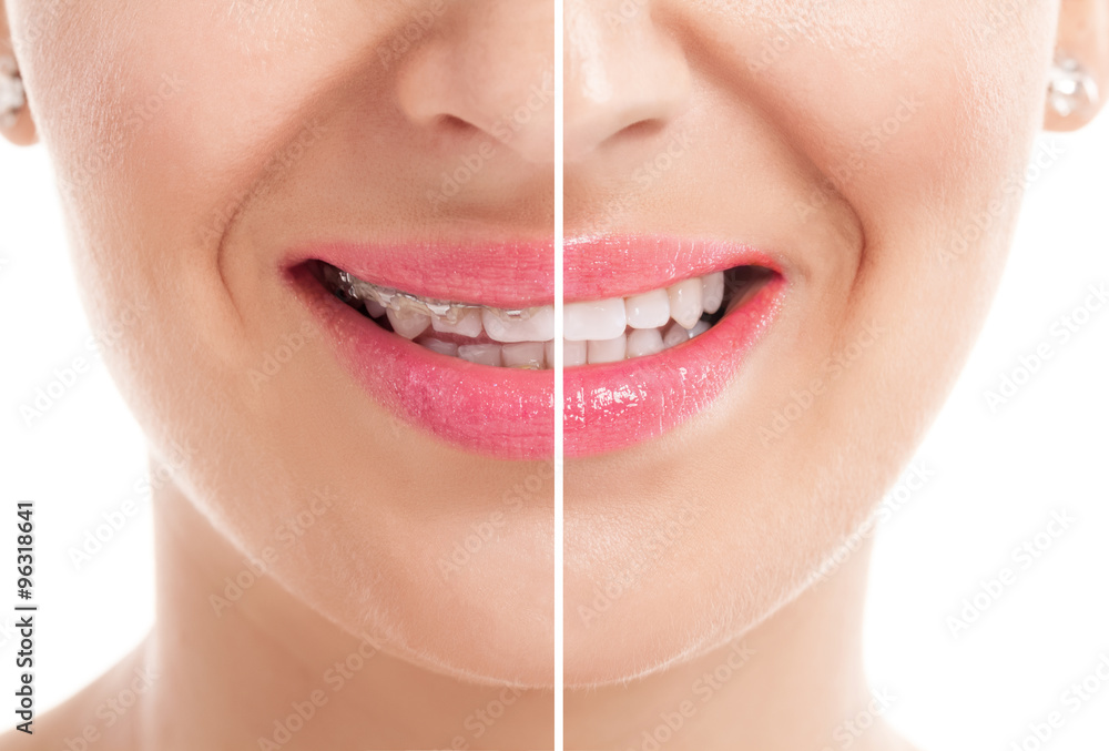 Naklejka premium Teeth with braces