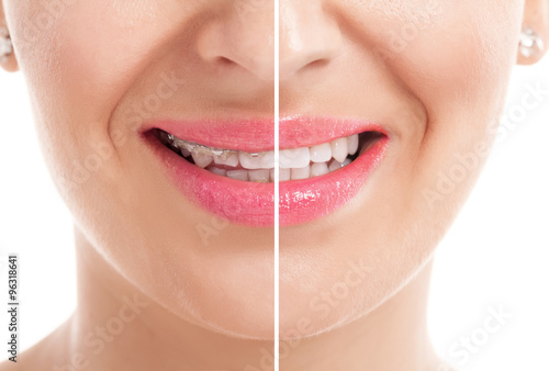 Teeth with braces
