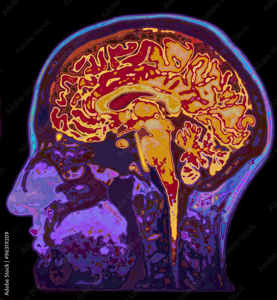 MRI Image Of Head Showing Brain Stock Photo | Adobe Stock
