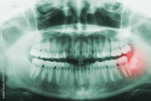 Panoramic dental X-Ray