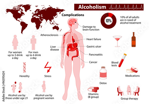 Alcoholism infographic