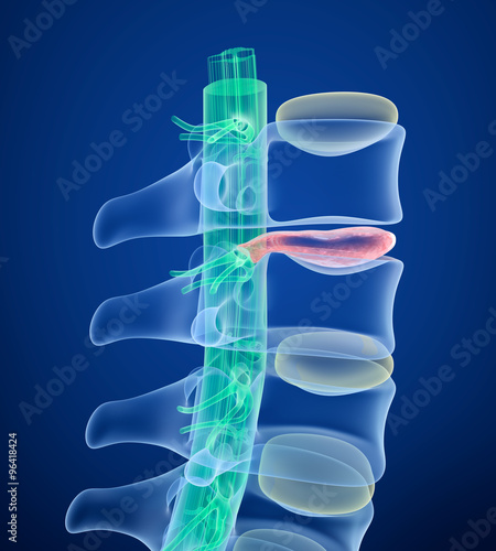 Φωτογραφία Spinal cord under pressure of bulging disc, X-Ray view