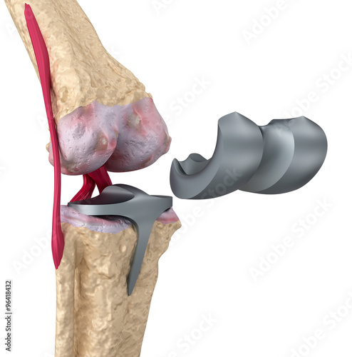 Fotografi Knee and titanium hinge joint. Isolated on white