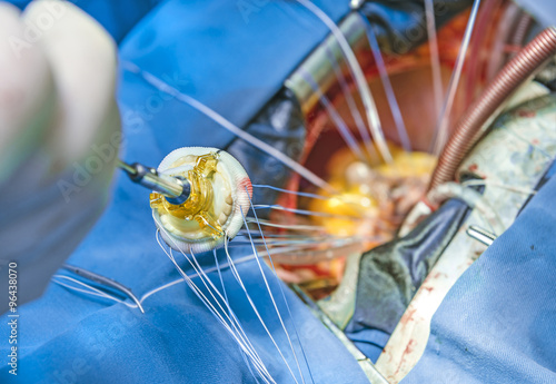 Valokuva Implantation of a biological heart valve