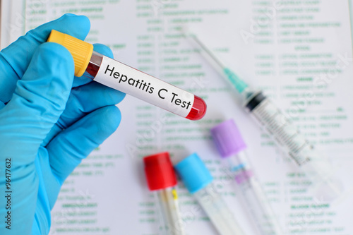 Blood for hepatitis C virus test photo