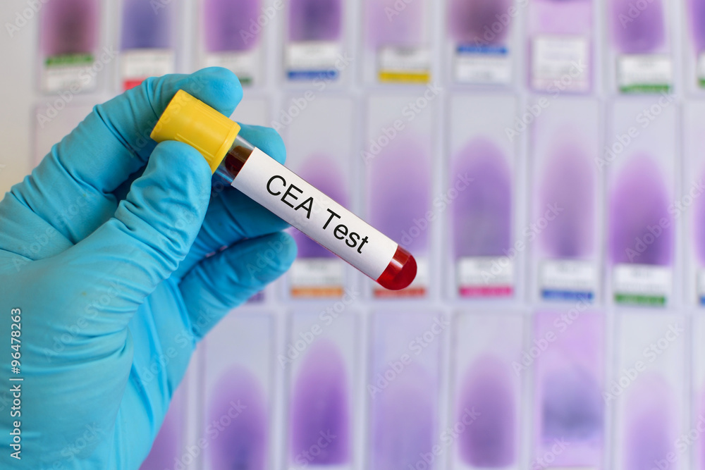 Blood for CEA (Carcinoembryonic antigen) test Stock Photo Adobe Stock