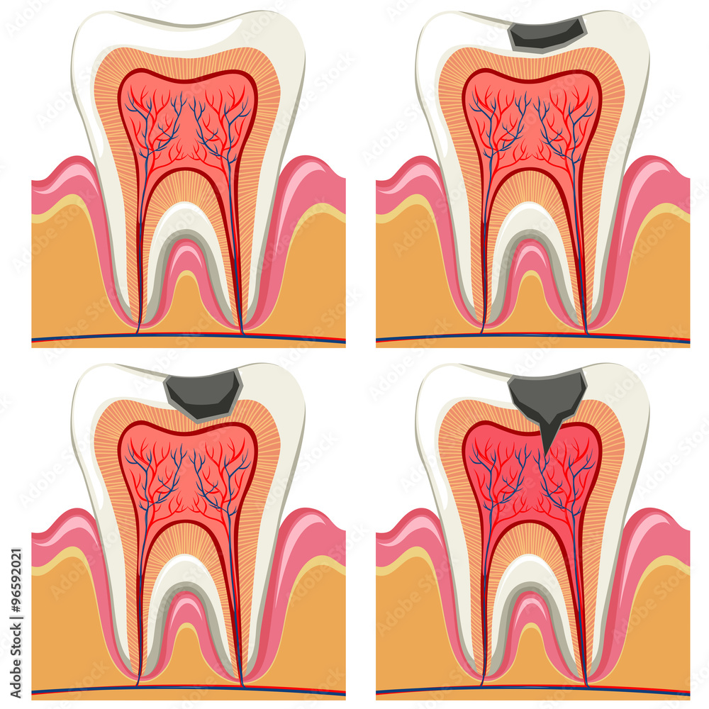 Tooth decay diagram in details Stock Vector Adobe Stock
