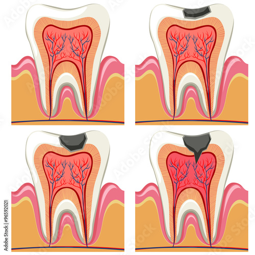 Tooth decay diagram in details